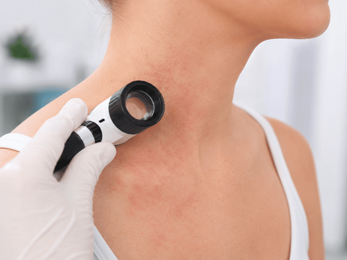 Dermatitis