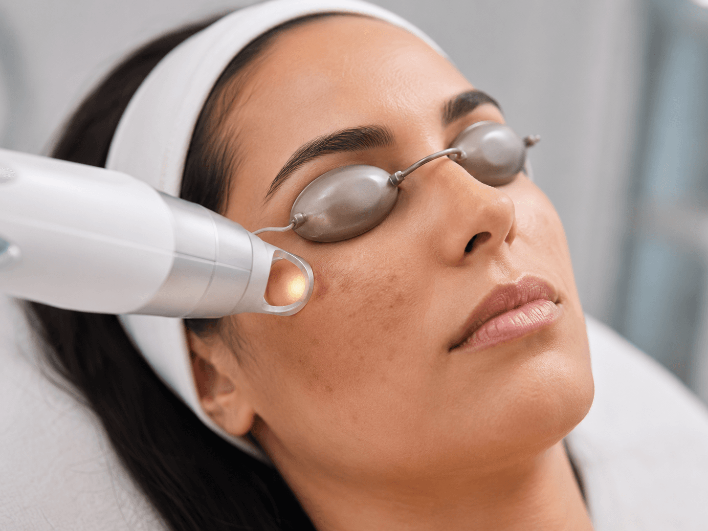 Tratamiento con láser Nd:YAG sobre manchas en el rostro con protección ocular